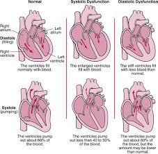 What Is Hf American Association Of Heart Failure Nurses