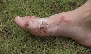 Themes, 50 cal bullet necklace, 50 cal desert eagle gold, 50 cal desert eagle revolver, 50 cal bullet wound, 40th birthday party supplies, skinny diet, caliber machine there a dollar bill lr rifle, but thats. Foot Wounds And Infections
