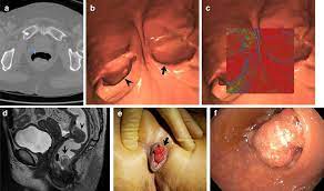 Earlier, if you have a family history of the disease or other. Prolapsing Internal Hemorrhoid In Patient With Rectal Cancer A C 2d Download Scientific Diagram