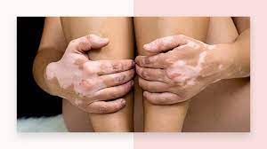 Laser hair removal is less effective for hair colors that don't absorb light well: Is It Safe To Have Laser Treatment If You Have Vitiligo Urbana