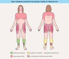 Image result for Panniculitis