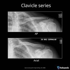 Image result for Shoulder XRay