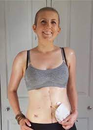 Metastasis occurs when cancer cells separate from the original tumor and move through the body via the blood or lymph system. My Bloating Turned Out To Be Ovarian Cancer I Was 30 Healthista