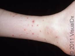 Image result for flea bite