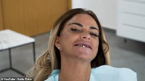 Hey guys, welcome back to my channel, in this video watch me and my partner carl get our teeth shaved down to pegs in preparation for our new veneers. Katie Price Spits Out Old Teeth As She Gets Her Veneers Replaced Oltnews