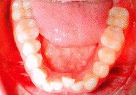 Sammlung von jette limette • zuletzt aktualisiert: Unsichtbare Zahnspange Zahnarztpraxis P Tomovic Frankfurt Westend