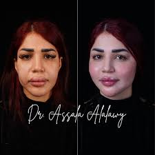 Harmony face technique ❤️‍🔥🥰 اذابة فلر الوجه القديم المحقون بطريقة خاطئة  وحقن الوجه بطريقة الشد والسحب 🥰❤️‍🔥 الدكتورة أصالة العلوي