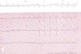 Diagnosis of constrictive pericarditis by tagged cine magnetic resonance. Diagnosis Of Acute Pericarditis