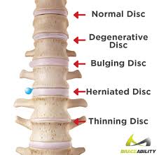 What does a bulging disc look like. Do I Have A Bulging Disc Back Cervical Bulged Disc Symptoms