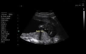 Pin On Amazing 4d Baby Scan Buckinghamshire Http Scan4d Co Uk Call 08000075076