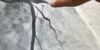 Image result for Nuclear Ventriculogram