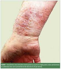 Image result for Rhus Dermatitis