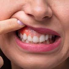 A lump or thickening in the lips, mouth, or cheek. Symptoms Mouth Cancer Foundation