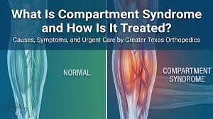 Image result for Compartment Syndrome