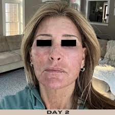 Another incredible result! These photos are taken ONE DAY post op and look  how fantastic she already looks! This is our in office mini face and neck  lift performed under a local