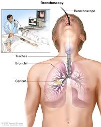 The actual diagnosis of lung cancer is made by looking at a sample of lung cells in the lab. Small Cell Lung Cancer Treatment Pdq Patient Version National Cancer Institute