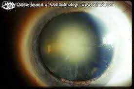 In latin, cataracta had the alternative meaning portcullis79 and the name possibly passed through french to form the english meaning eye disease (early 15th century), on the notion of obstruction. Atlas Of Ophthalmology
