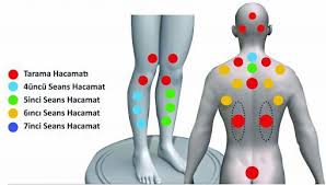 hacamat noktalari saglik terapi fibromiyalji