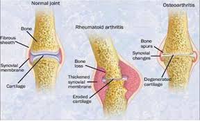 Nras National Rheumatoid Arthritis Society