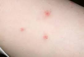 Image result for bedbugs bites