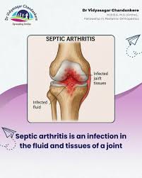 Image result for Septic Joint