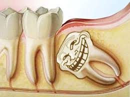 With the help of these pictures the oral and maxillofacial surgeon can frequently predict if the wisdom teeth are going to cause trouble, either in the near future or later in life. Looks Like You Ll Need Braces Wisdom Teeth Teeth Wisdom Tooth Extraction