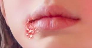 Bạn đã biết bệnh hạ cam mềm là gì chưa?