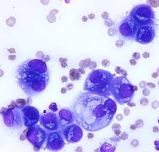 Maybe you would like to learn more about one of these? Invasive Pleural Malignant Mesothelioma With Rib Destruction And Concurrent Osteosarcoma In A Dog Acta Veterinaria Scandinavica Full Text