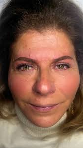 HIFU 1 session ✨✨✨✨✨ You can see the lift and it only gets better with  time!!! Imagine the glow in real life. Non invasive, no downtime, just  tighter, firmer, younger looking skin