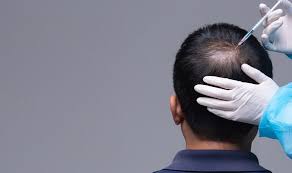 I use amla powder extensively in hair care. Hair Loss Treatment Amla Powder Shown To Stop Alopecia Express Co Uk