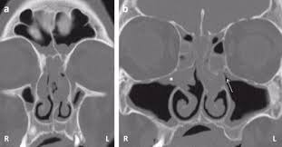 Genetics may play a role in the development of nasal polyps, along with having other health conditions involving inflammation of tissue and/or the upper respiratory tract, like chronic rhinosinusitis and allergic rhinitis (hay fever). Nasal Polyposis Or Chronic Olfactory Rhinitis Sciencedirect