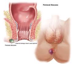 Image result for Perirectal Abscess