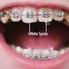 Will i have advance notice that my braces are going to come off? 1