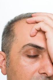 Symptoms of gradual hair loss are sometimes hard to notice until nearly half the hair is gone. 5 Early Signs You Re Going Bald Fight Hair Loss Immediately