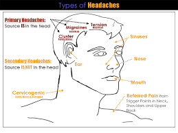 Headache Location Chart Meme Www Bedowntowndaytona Com