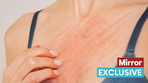 Image result for skin rash similar to scabies