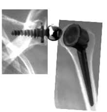 Published may 05, 21 4:40am. Shoulder Arthroplasty Historical Considerations Fulltext