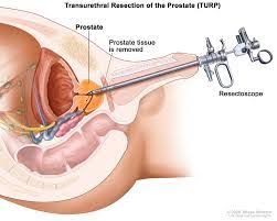 Pin On Prostate Cancer Treatment Home And Natural Remdies