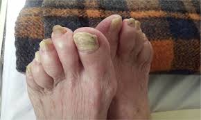 Image result for Onychogryphosis feet