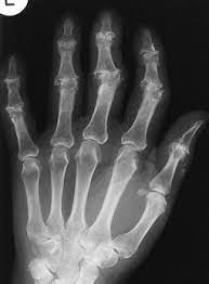 Joint arthroplasty /.the skin that the videos claim to show (if you want to give this a go, try getting a fridge magnet to pick up anything. Indikation Zur Fingermittelgelenkendoprothetik Bei Patienten Ohne Rheumatische Erkrankung Springerlink