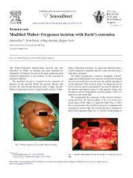 8 the extent of the tumor. Pdf Modified Weber Fergusson Incision With Borle S Extension Anshul Rai Academia Edu