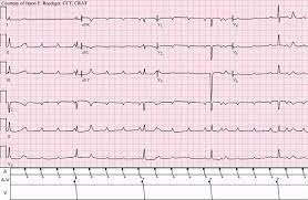 We did not find results for: Diagnosis Av Block Alomedika