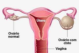 5 Sintomas De Cisto No Ovario Com Teste Online Tua Saude