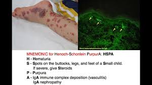 It looks like a rash or purple or red dots. Henoch Schonlein Purpura Hsp Mnemonic Youtube