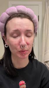 Fiona Frolls Pimple Patch