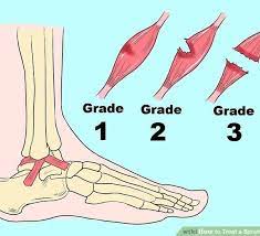 Patients with a grade ii sprain have significant swelling and pain. Ankle Sprain Foot Ankle Experts