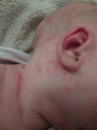 Image result for vyrážka u dětí