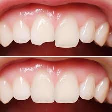 Our dentist will roughen your tooth and put on a conditioning liquid. How To Fix Rotting Teeth At Home Teethwalls