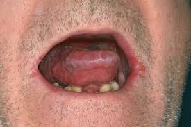Image result for Angular Stomatitis