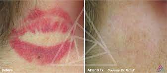 Only natural products are used to remove tattoo ink. Astanza Tattoo Removal Before After Photos Tattoo Removal Results